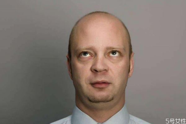 脫發(fā)造成的原因有什么呢 會什么會脫發(fā)呢 脫發(fā)造成的原因有什么呢 會什么會脫發(fā)呢