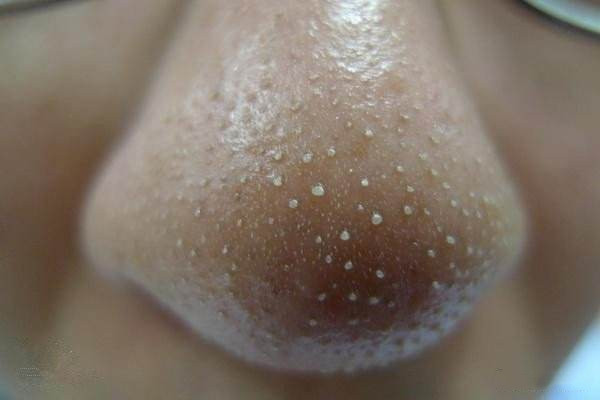 去黑頭后如何收縮毛孔 如何預(yù)防改善黑頭 去黑頭后如何收縮毛孔 如何預(yù)防改善黑頭