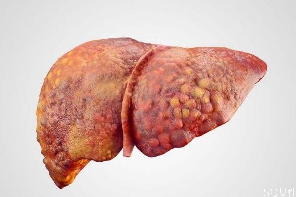肝硬化造成的原因有什么呢 為什么會(huì)得肝硬化呢