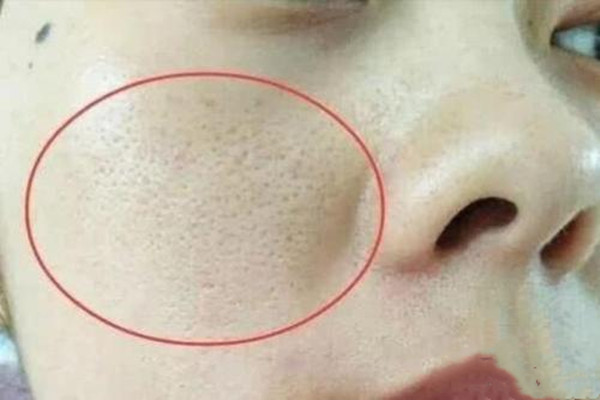 毛孔堵塞的癥狀 如何預(yù)防毛孔堵塞 毛孔堵塞的癥狀 如何預(yù)防毛孔堵塞