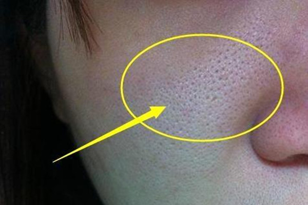 毛孔堵塞的癥狀 如何預(yù)防毛孔堵塞 毛孔堵塞的癥狀 如何預(yù)防毛孔堵塞