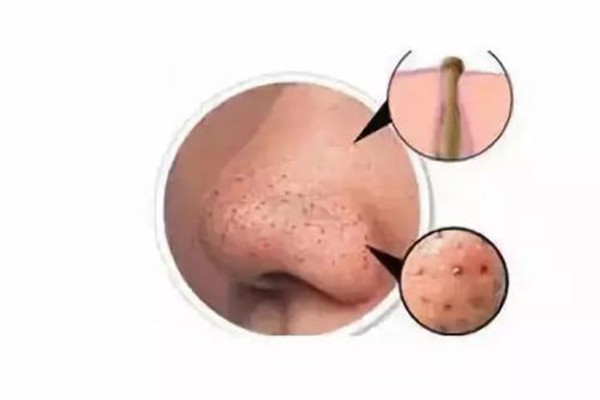 毛孔堵塞的癥狀 如何預(yù)防毛孔堵塞 毛孔堵塞的癥狀 如何預(yù)防毛孔堵塞