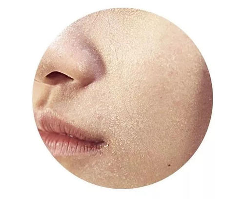 臉上化妝的地方起皮怎么辦 皮膚起皮怎么護理