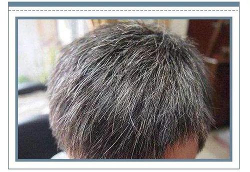 焦慮會(huì)長(zhǎng)白頭發(fā)嗎 白頭發(fā)如何預(yù)防