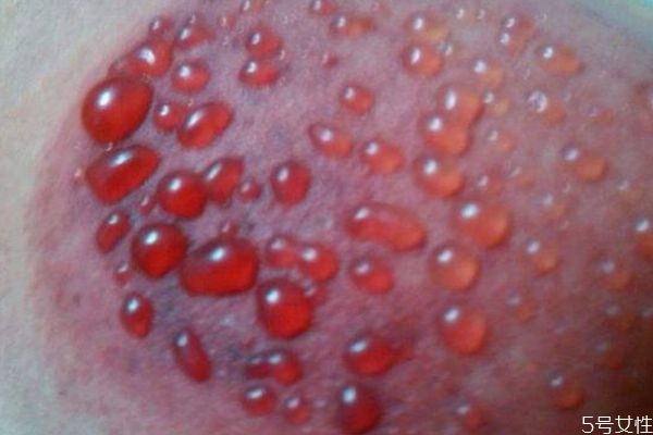 拔罐一般用的是什么 拔罐過多久可以洗澡 拔罐一般用的是什么 拔罐過多久可以洗澡