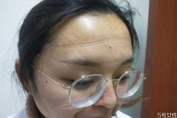 長時間戴口罩對皮膚的影響 戴口罩應該怎么護膚 長時間戴口罩對皮膚的影響 戴口罩應該怎么護膚