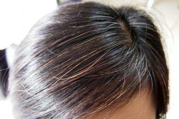 如何減少白頭發(fā) 減少白頭發(fā)的方法有什么 如何減少白頭發(fā) 減少白頭發(fā)的方法有什么