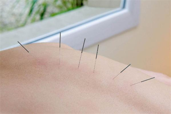針灸減肥一個(gè)療程多少錢 針灸減肥一個(gè)療程是幾天 針灸減肥一個(gè)療程多少錢 針灸減肥一個(gè)療程是幾天