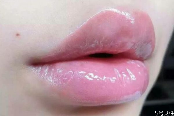 打完嘟嘟唇多久能自然 打完嘟嘟唇多久恢復(fù) 打完嘟嘟唇多久能自然 打完嘟嘟唇多久恢復(fù)