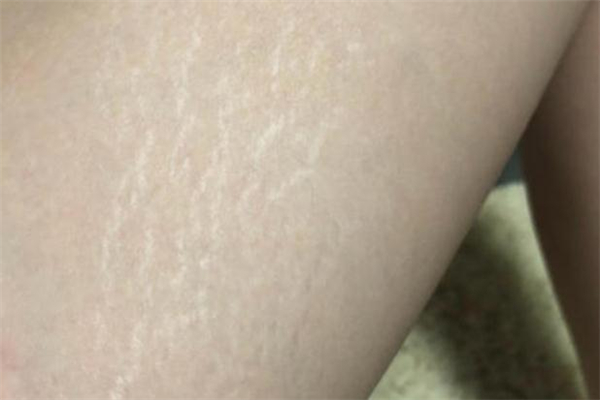 減肥后出現(xiàn)肥胖紋怎么辦 減肥后出現(xiàn)的肥胖紋會(huì)消失嗎 減肥后出現(xiàn)肥胖紋怎么辦 減肥后出現(xiàn)的肥胖紋會(huì)消失嗎