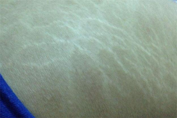 肥胖紋是什么顏色 紅色肥胖紋怎么去除 肥胖紋是什么顏色 紅色肥胖紋怎么去除