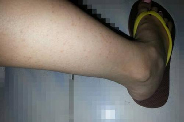 毛角周化好發(fā)于什么年齡 毛角周化什么年齡容易長