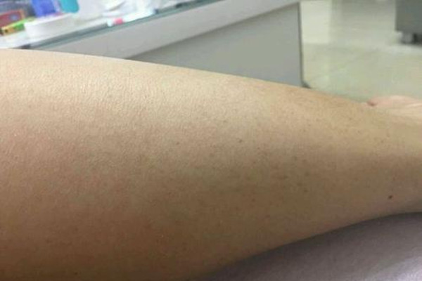 毛角周化好發(fā)于什么年齡 毛角周化什么年齡容易長