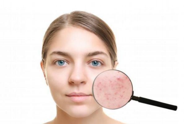 臉部過敏怎么辦 解決臉部過敏的方法 臉部過敏怎么辦 解決臉部過敏的方法