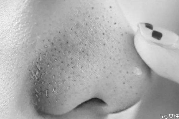 如何高效去黑頭 快速去黑頭的方法 如何高效去黑頭 快速去黑頭的方法