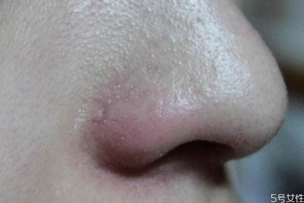 如何高效去黑頭 快速去黑頭的方法 如何高效去黑頭 快速去黑頭的方法