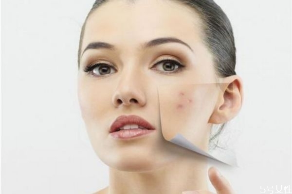 針清痘痘后多久會好 針清的注意事項 針清痘痘后多久會好 針清的注意事項