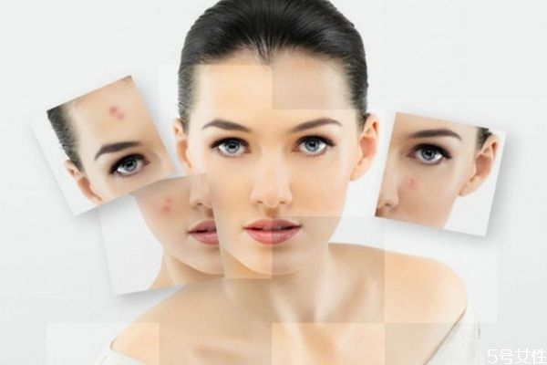 針清痘痘后多久會好 針清的注意事項 針清痘痘后多久會好 針清的注意事項