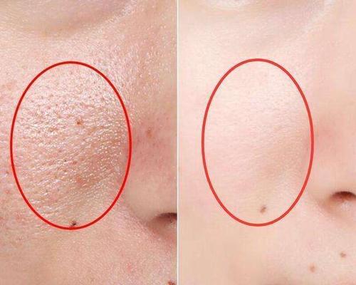 毛孔粗大怎么辦 預防毛孔粗大的方法 毛孔粗大怎么辦 預防毛孔粗大的方法