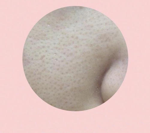 毛孔粗大怎么辦 預防毛孔粗大的方法 毛孔粗大怎么辦 預防毛孔粗大的方法