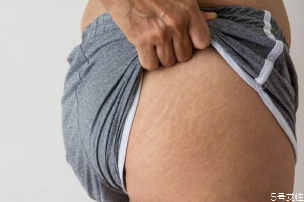 青春期生長紋如何消除 青春期生長紋消除方法