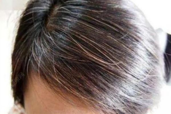 為啥白頭發(fā)染不上色 讓白頭發(fā)變黑的方法 為啥白頭發(fā)染不上色 讓白頭發(fā)變黑的方法