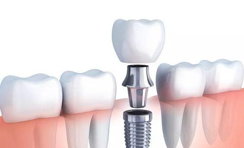種植牙齒多少錢(qián)一顆 種植牙齒的價(jià)格受什么影響