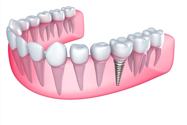 種植牙齒二期幾天能拆線 種植牙齒多久能好 種植牙齒二期幾天能拆線 種植牙齒多久能好