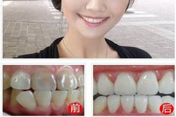 哪些人不適合戴隱形牙套 戴隱形牙套要注意什么 哪些人不適合戴隱形牙套 戴隱形牙套要注意什么