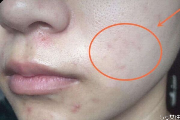 黑色痘印能自己消失嗎 黑色痘印自己可以消失嗎 黑色痘印能自己消失嗎 黑色痘印自己可以消失嗎