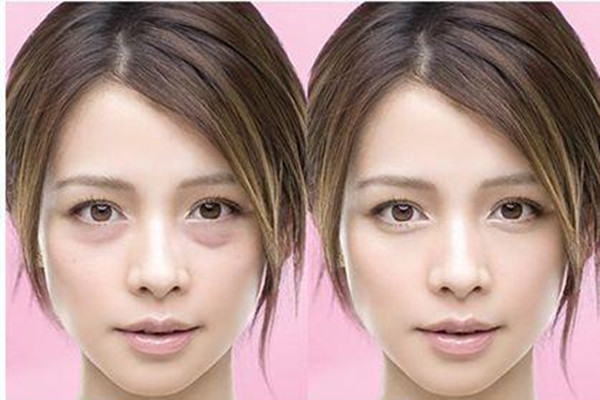 超聲波去眼袋價格是多少 超聲波去眼袋術前要注意什么