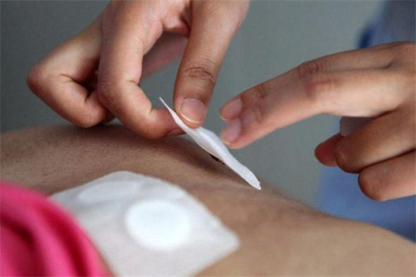 三伏貼一次貼幾張 貼三伏貼要忌口多長時間 三伏貼一次貼幾張 貼三伏貼要忌口多長時間