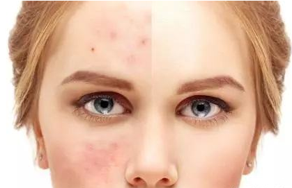 刷酸后用洗嗎 刷酸后可以敷面膜嗎 刷酸后用洗嗎 刷酸后可以敷面膜嗎