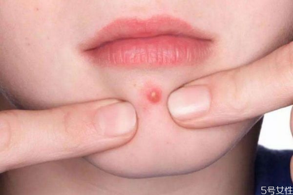 如何正確擠痘 你會(huì)正確的擠痘痘嗎