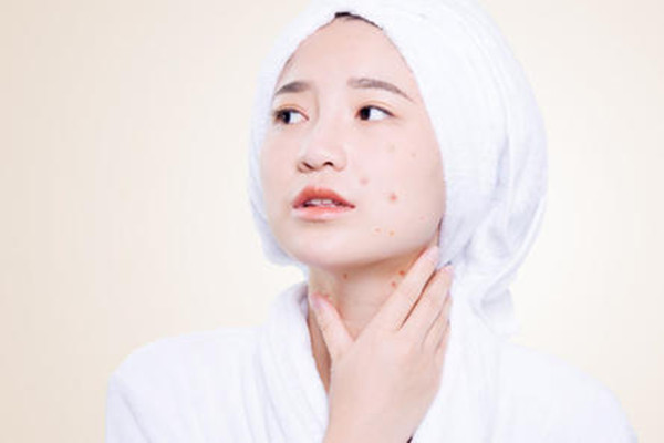 如何度過水楊酸爆痘期 度過水楊酸爆痘期的方法 如何度過水楊酸爆痘期 度過水楊酸爆痘期的方法