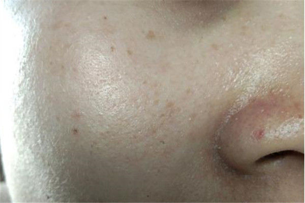 鼻子兩側毛孔粗大原因及怎么改善