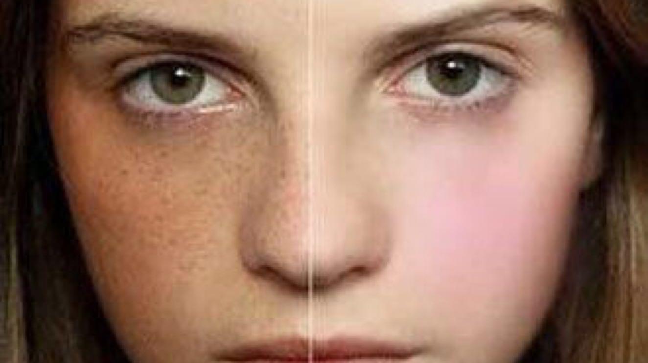 黃褐斑是什么原因引起的 黃褐斑怎么去除最有效 黃褐斑是什么原因引起的 黃褐斑怎么去除最有效