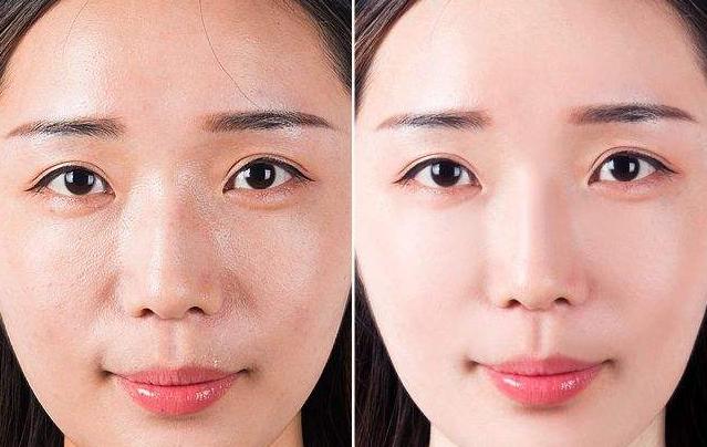 控油是不是去油的意思 怎樣面部控油最有效 控油是不是去油的意思 怎樣面部控油最有效