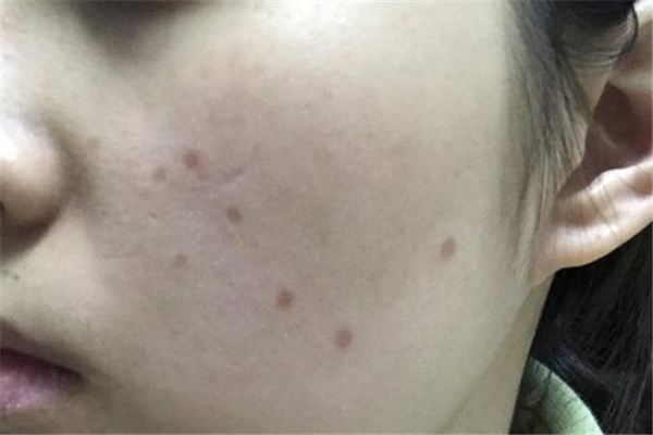 點(diǎn)痣有風(fēng)險(xiǎn)嗎 點(diǎn)痣需要注意哪些事項(xiàng) 點(diǎn)痣有風(fēng)險(xiǎn)嗎 點(diǎn)痣需要注意哪些事項(xiàng)