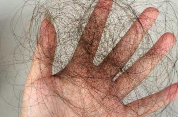 產后脫發(fā)嚴重怎么治療才有效 產后脫發(fā)原因是什么