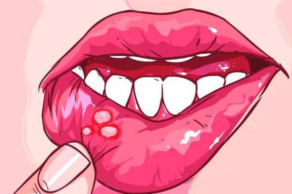 口腔潰瘍可以吃葡萄嗎 口腔潰瘍吃什么好的快 口腔潰瘍可以吃葡萄嗎 口腔潰瘍吃什么好的快
