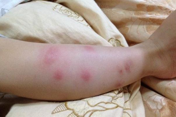 新生兒濕疹能曬太陽(yáng)嗎 新生兒濕疹能用碘伏嗎