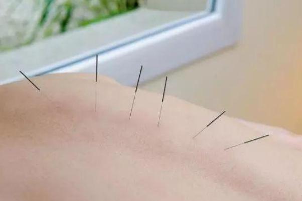 針灸有危險(xiǎn)嗎 針灸有什么好處和壞處 針灸有危險(xiǎn)嗎 針灸有什么好處和壞處