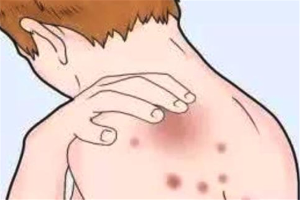 蕁麻疹中醫(yī)能治好嗎 蕁麻疹中醫(yī)調(diào)理需要多長時間好 蕁麻疹中醫(yī)能治好嗎 蕁麻疹中醫(yī)調(diào)理需要多長時間好