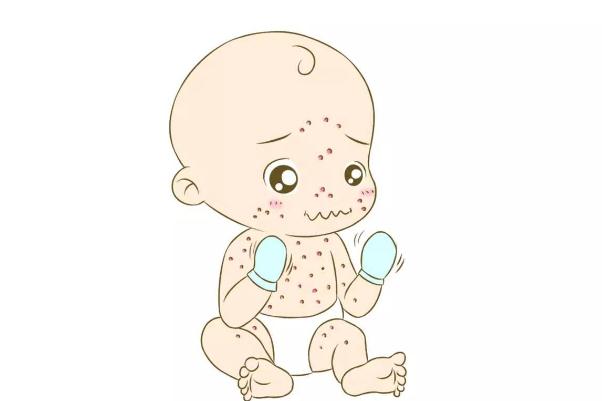 寶寶濕疹反反復(fù)復(fù)怎么根除 寶寶濕疹反復(fù)不斷是什么原因 寶寶濕疹反反復(fù)復(fù)怎么根除 寶寶濕疹反復(fù)不斷是什么原因