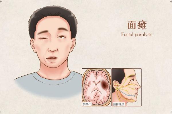 面癱針灸多久會(huì)好 面癱針灸治療最佳時(shí)間