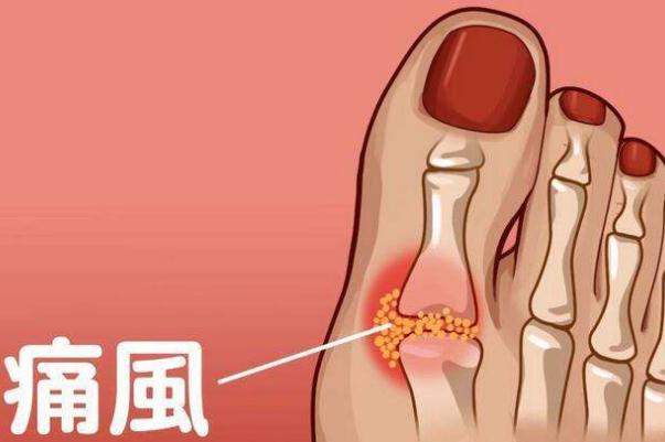 痛風(fēng)吃什么藥快速消腫止痛 痛風(fēng)如何簡單預(yù)防 痛風(fēng)吃什么藥快速消腫止痛 痛風(fēng)如何簡單預(yù)防