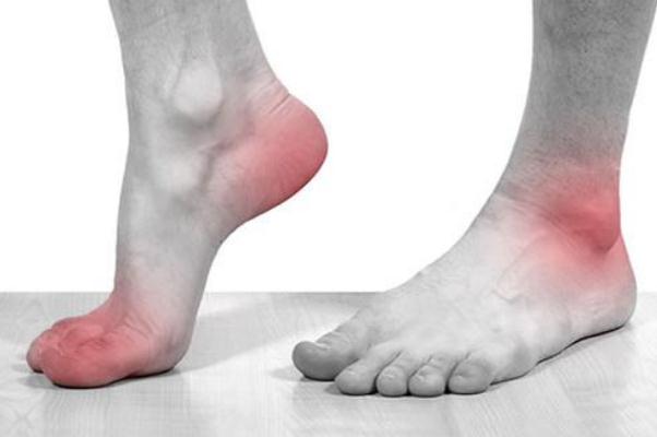 痛風(fēng)是什么原因引起的 痛風(fēng)有哪些癥狀 痛風(fēng)是什么原因引起的 痛風(fēng)有哪些癥狀