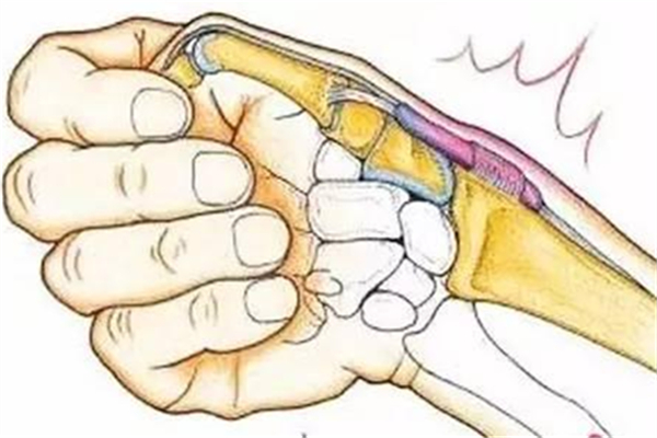 腱鞘炎會(huì)不會(huì)自愈 腱鞘炎會(huì)越來(lái)越腫嗎