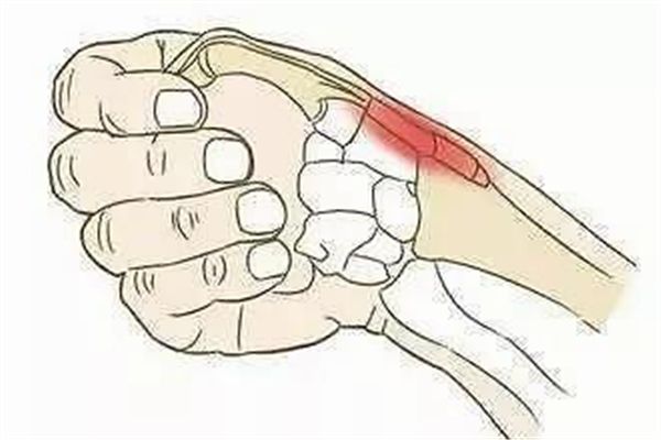 腱鞘炎對(duì)身體有什么危害 腱鞘炎對(duì)生活有影響嗎 腱鞘炎對(duì)身體有什么危害 腱鞘炎對(duì)生活有影響嗎